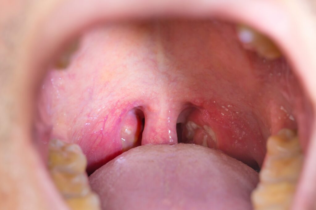 tonsils stones