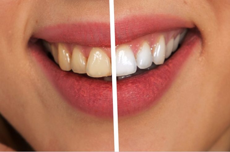 Teeth Whitening Teeth Whitening