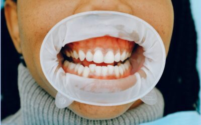 What Does It Mean If You Have White Stuff On Your Gums?