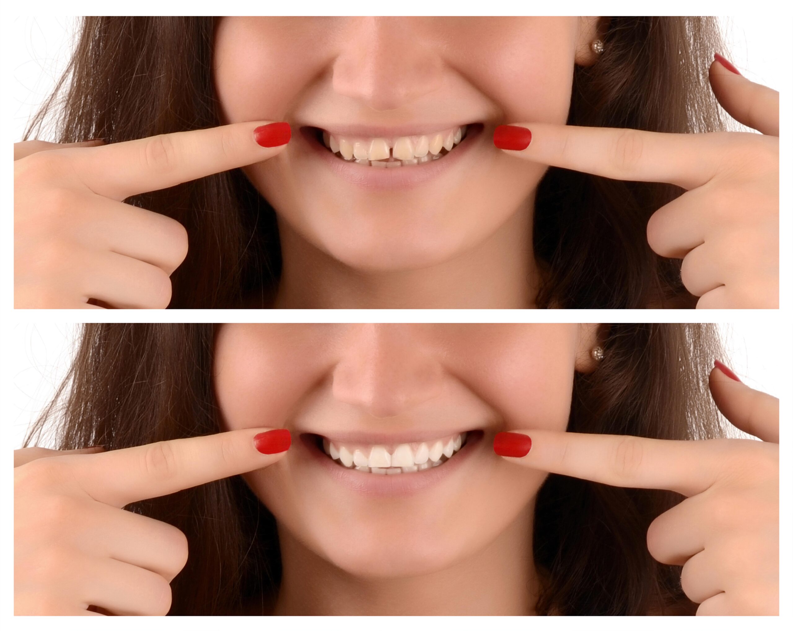Teeth Whitening