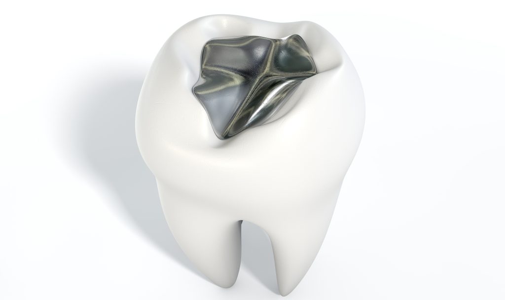 What to do when you lose a filling, how to use temporary dental filling  material. 