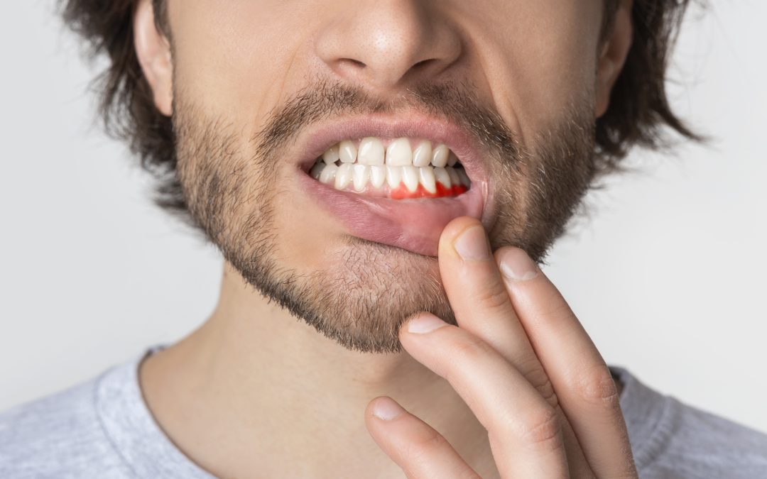 Your Gums Are Bleeding. Now What?
