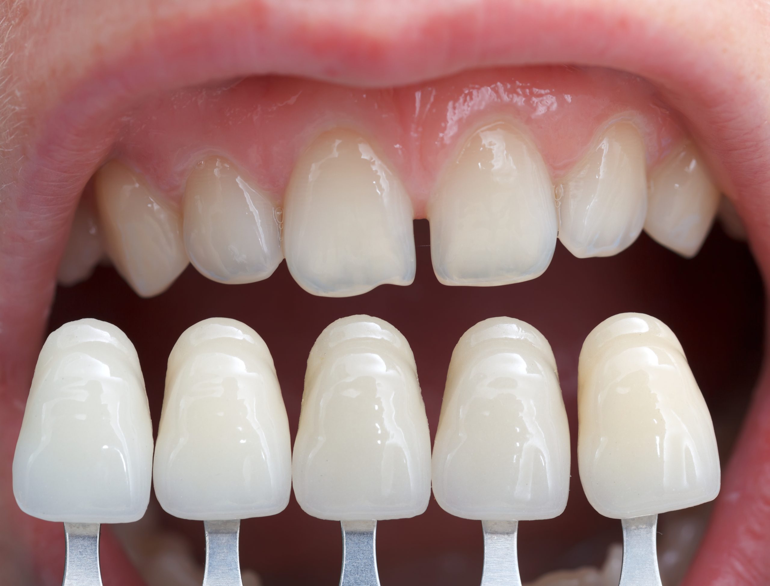 Shade determination Teeth Whitening