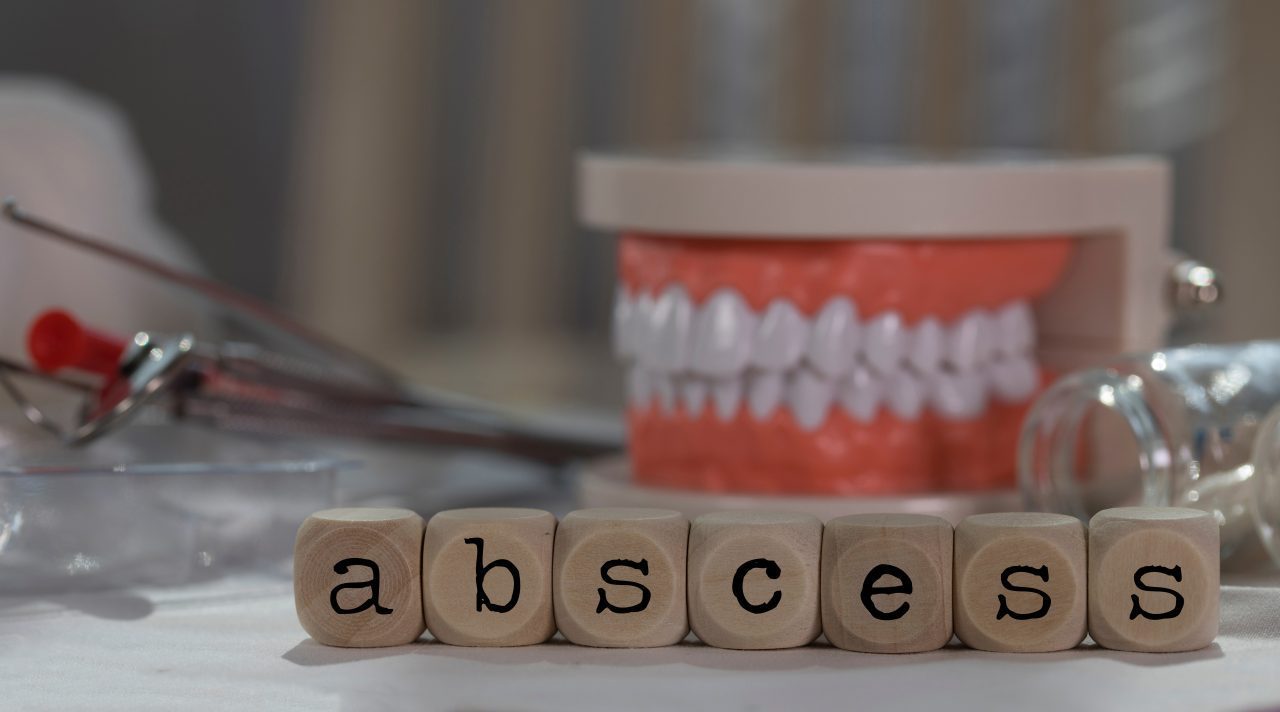 Understanding an Abscessed Tooth Causes, Symptoms, and Treatment