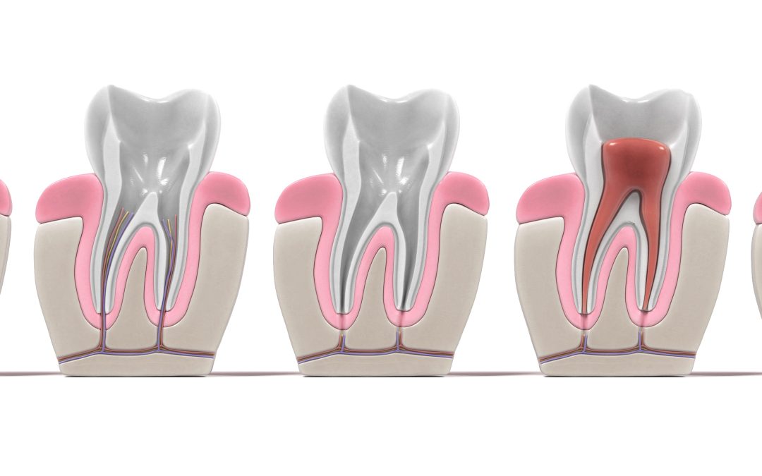 Getting to the Root of Root Canals 
