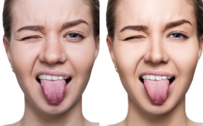 Everything You Need to Know About White Spots on the Tongue