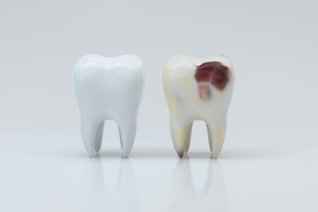 The Stages of Tooth Decay: Everything You Need to Know - Patient ...