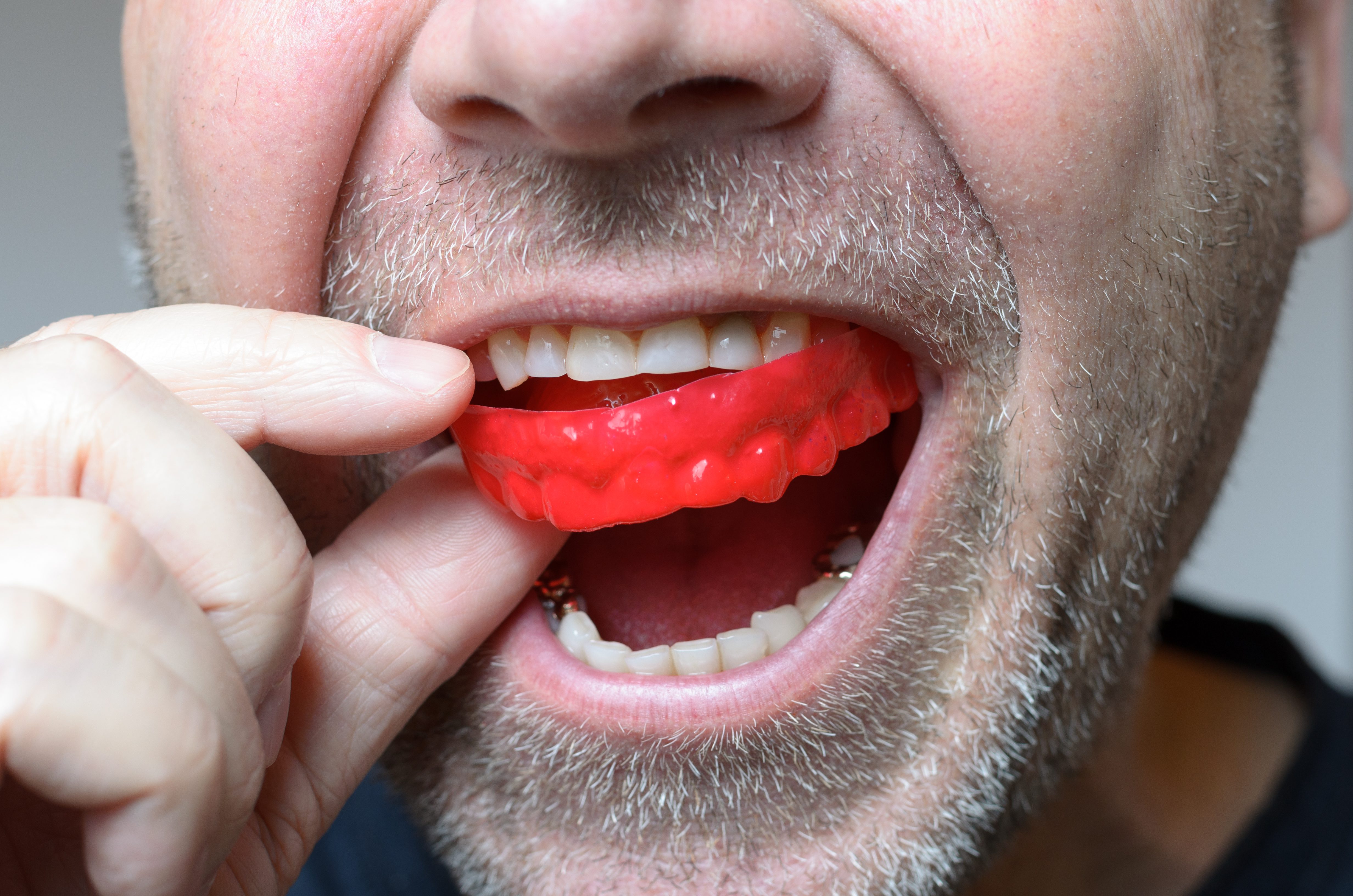 Splitting Teeth: A Friendly Guide to Understanding and Preventing Tooth ...
