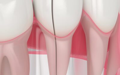 Splitting Teeth: A Friendly Guide to Understanding and Preventing Tooth Cracks