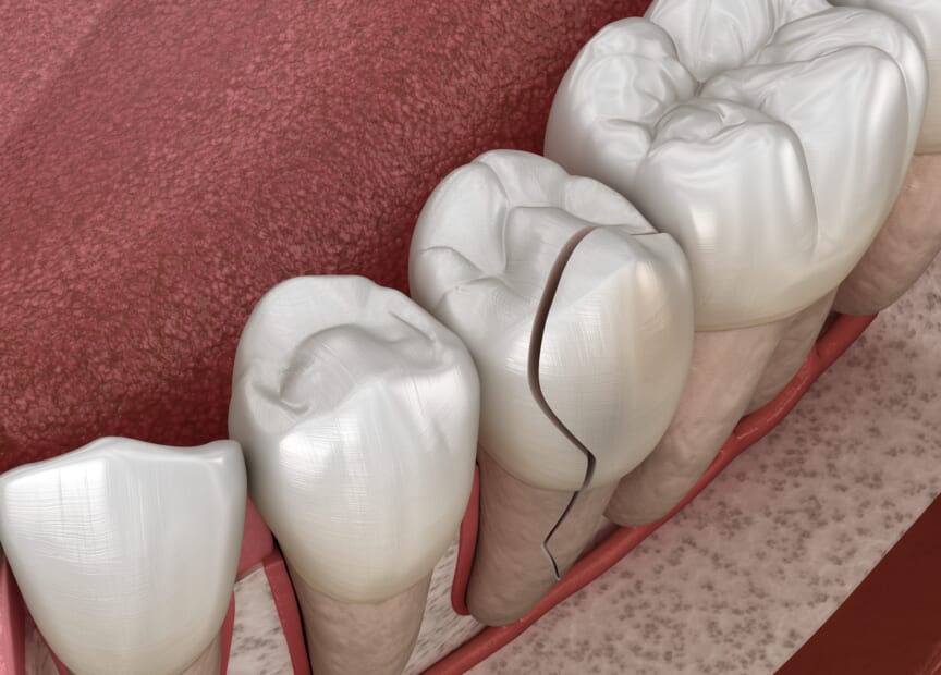 Splitting Teeth: A Friendly Guide to Understanding and Preventing Tooth ...