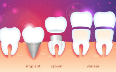 How Much Do Veneers Cost with Insurance: A Guide to Your Perfect Smile