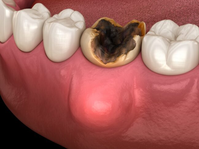 Eruption Abscess Understanding Gum Abscesses: A Comprehensive Guide - Patient Empowered ...