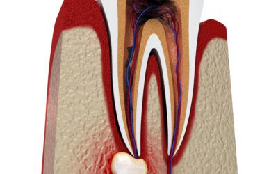 Understanding Gum Abscesses: A Comprehensive Guide