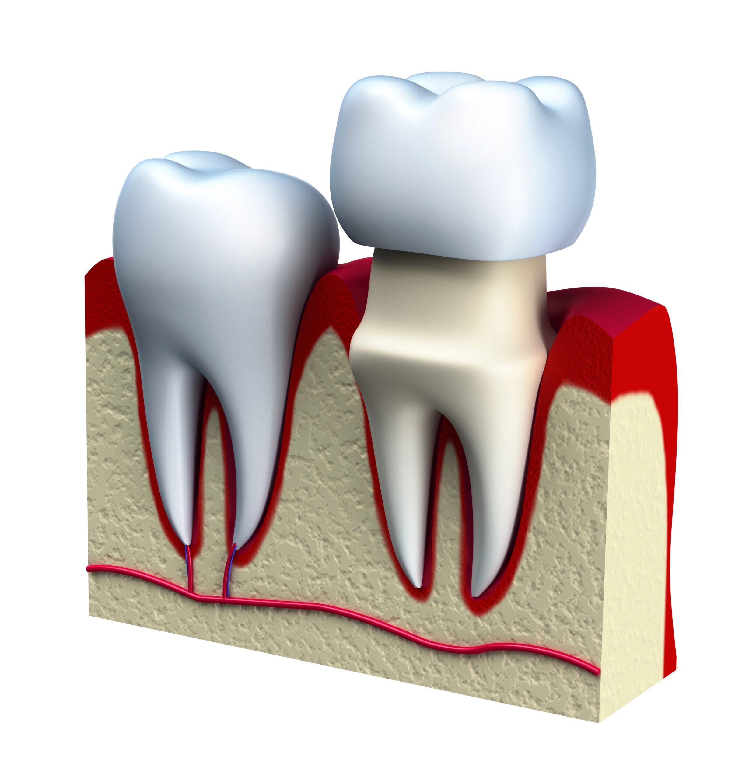 Teeth Whitening