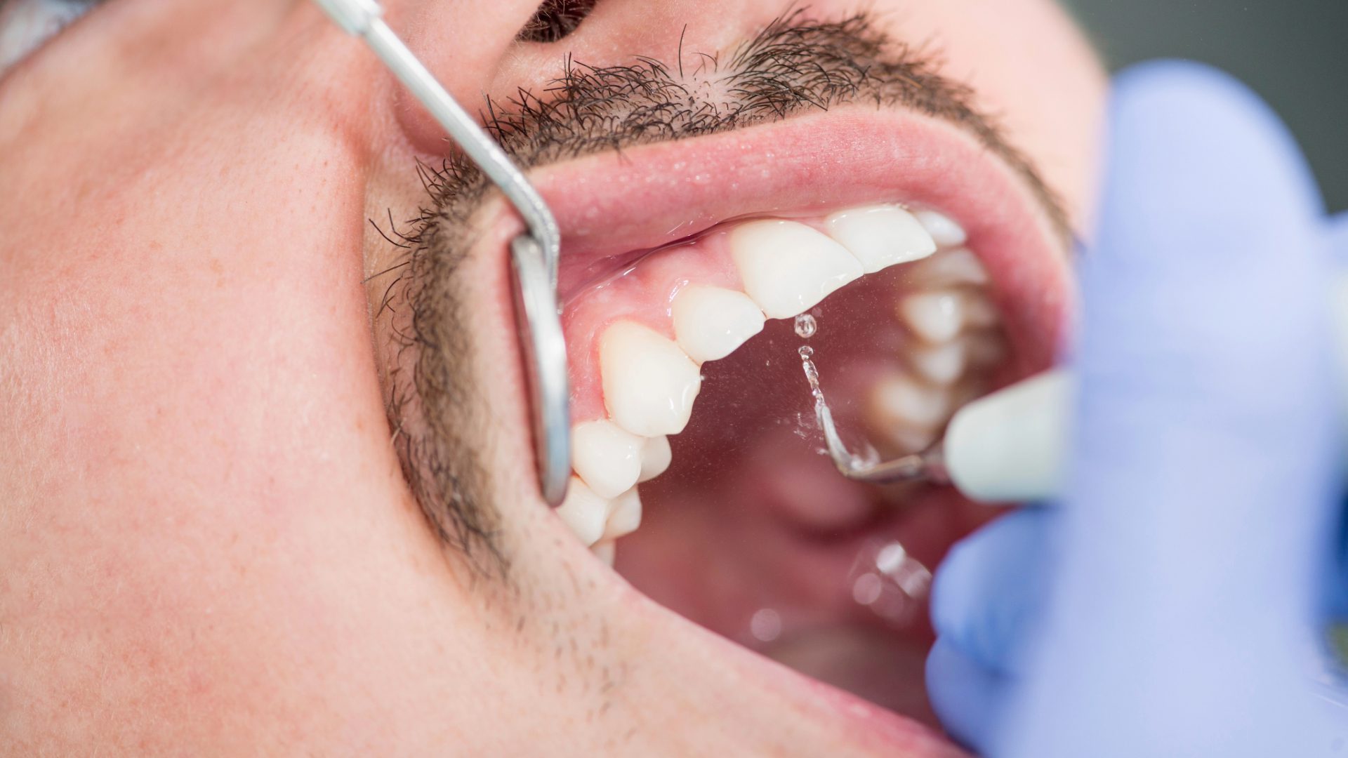 Patient Empowered Dentistry - Do Crowns Break Easily Understanding Dental Crown Durability - When to See Your Dentist Teeth Whitening