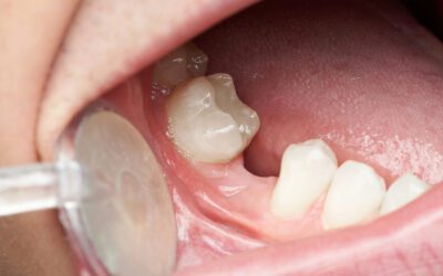 So You’re Getting a Tooth Pulled? Your Week-by-Week Recovery Guide
