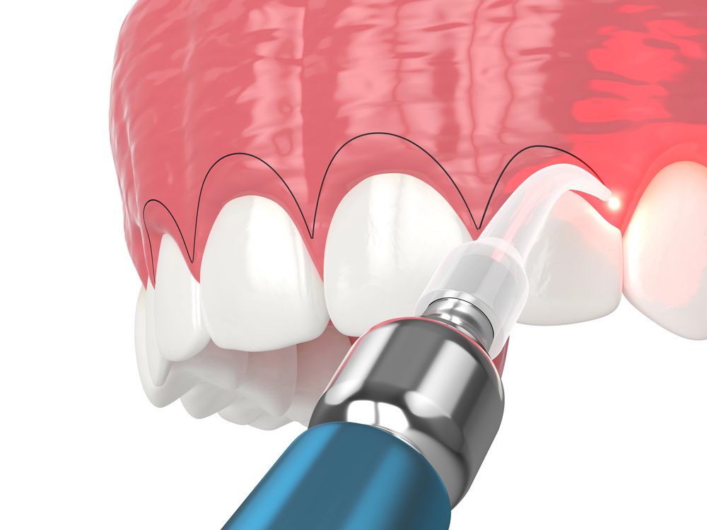 Dental Implant