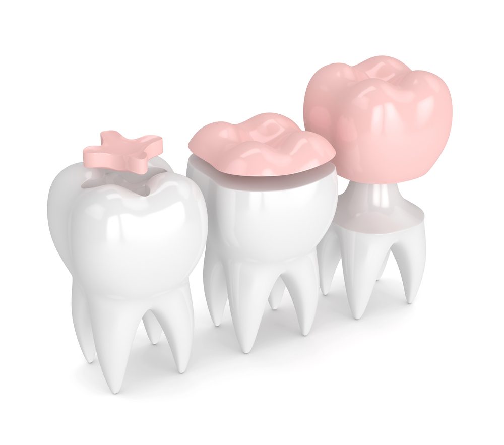 Dental Implant