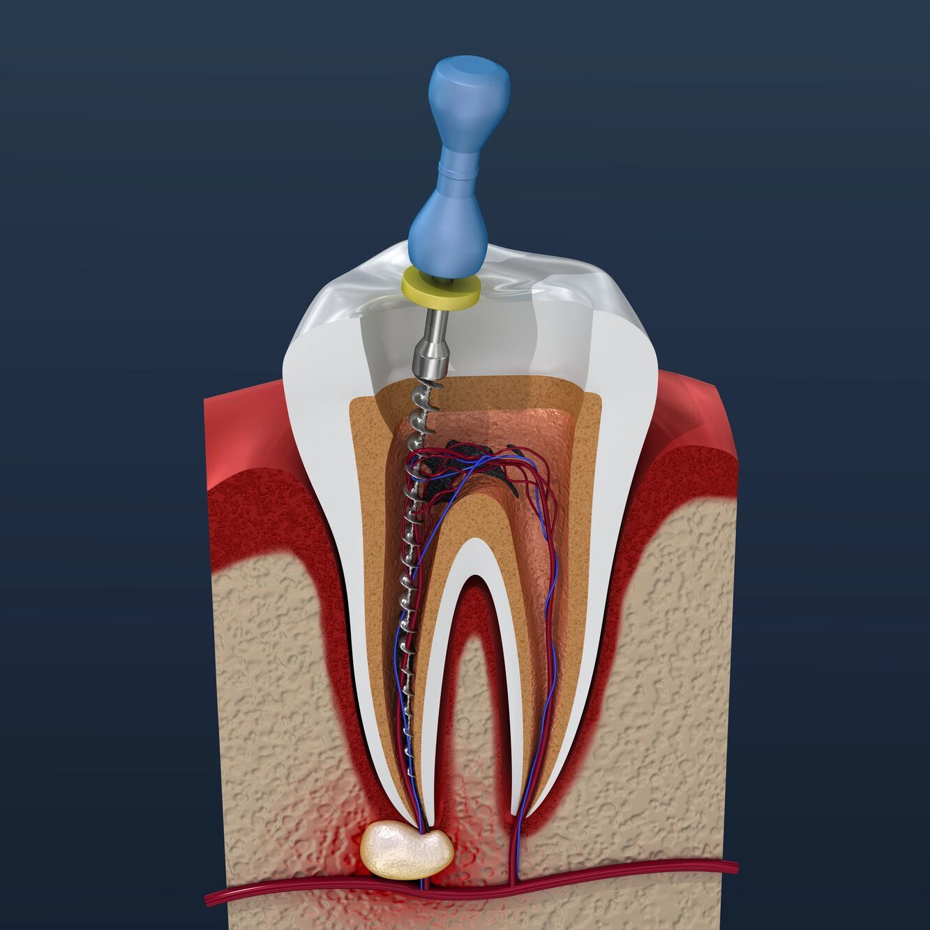 Root Canal Therapy Dental Implant