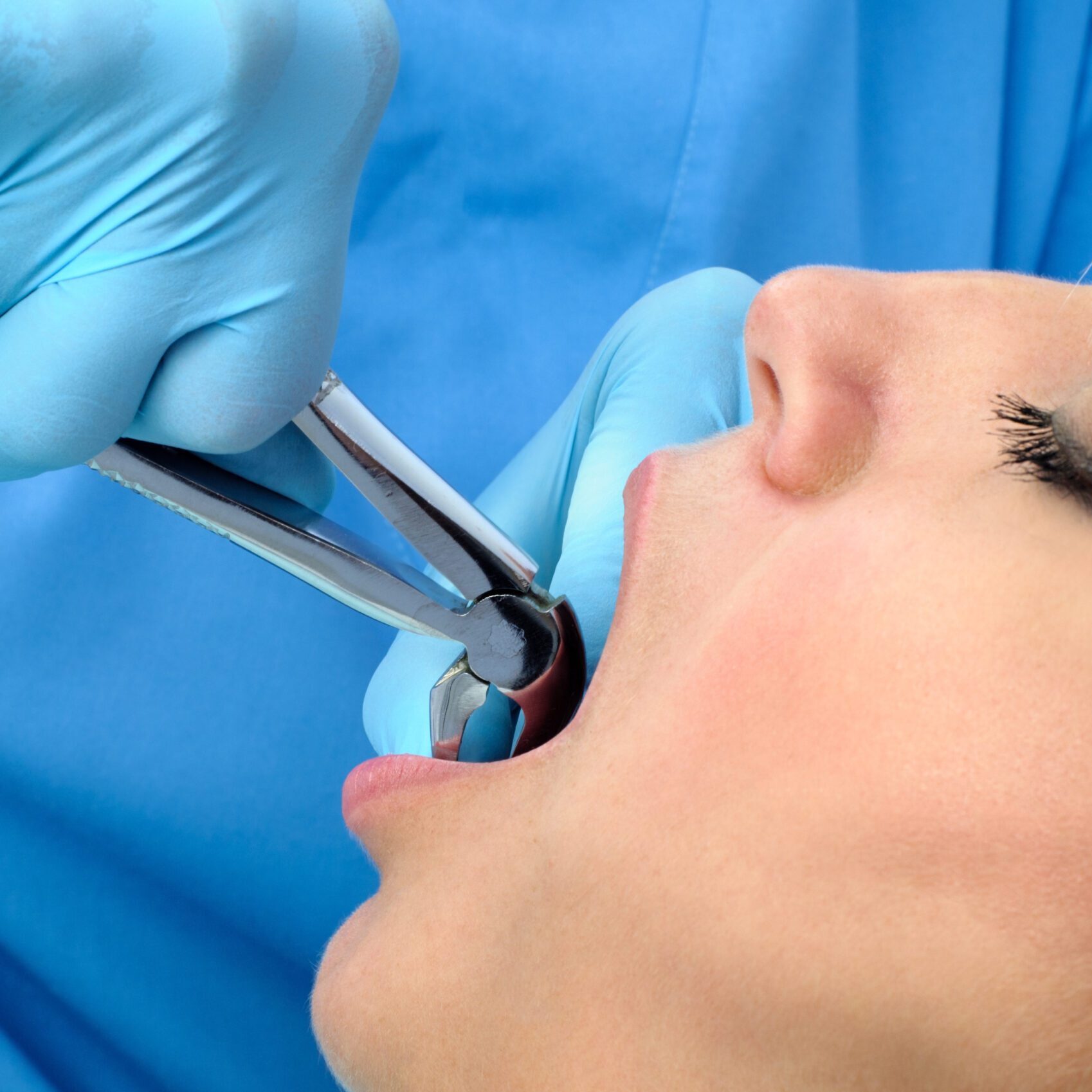 Tooth extraction Dental Implant